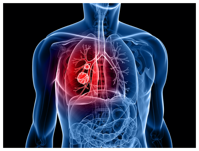 CancerFreeSC's tweet image. Lung Cancer in South Carolina. Approximately 3,896 people are diagnosed with lung cancer and 2,797 die from the disease each year.