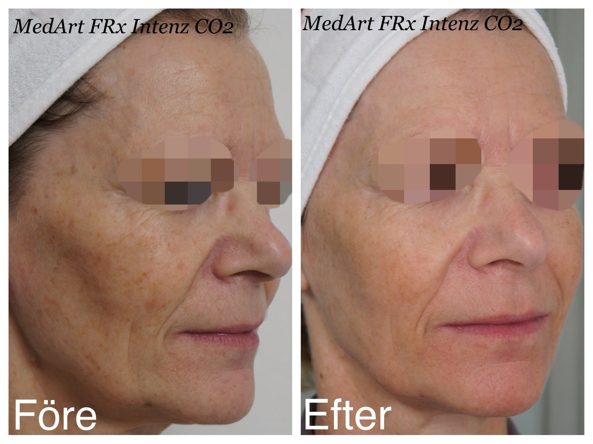a_medart's tweet photo. Full Face Treatment of Fractional Laser by MedArt FRx Intenz CO2 @doctorryskinclinic 👍👍💐💐
non-invasive, fast recovery &amp; effective resurfacing.
👍 with MedArt Scanner, full face treatment takes less than 30 minutes.
Visit: https://t.co/UGp7TxwGIv
#co2laser #fractionsllaser https://t.co/dYm00hOL4F