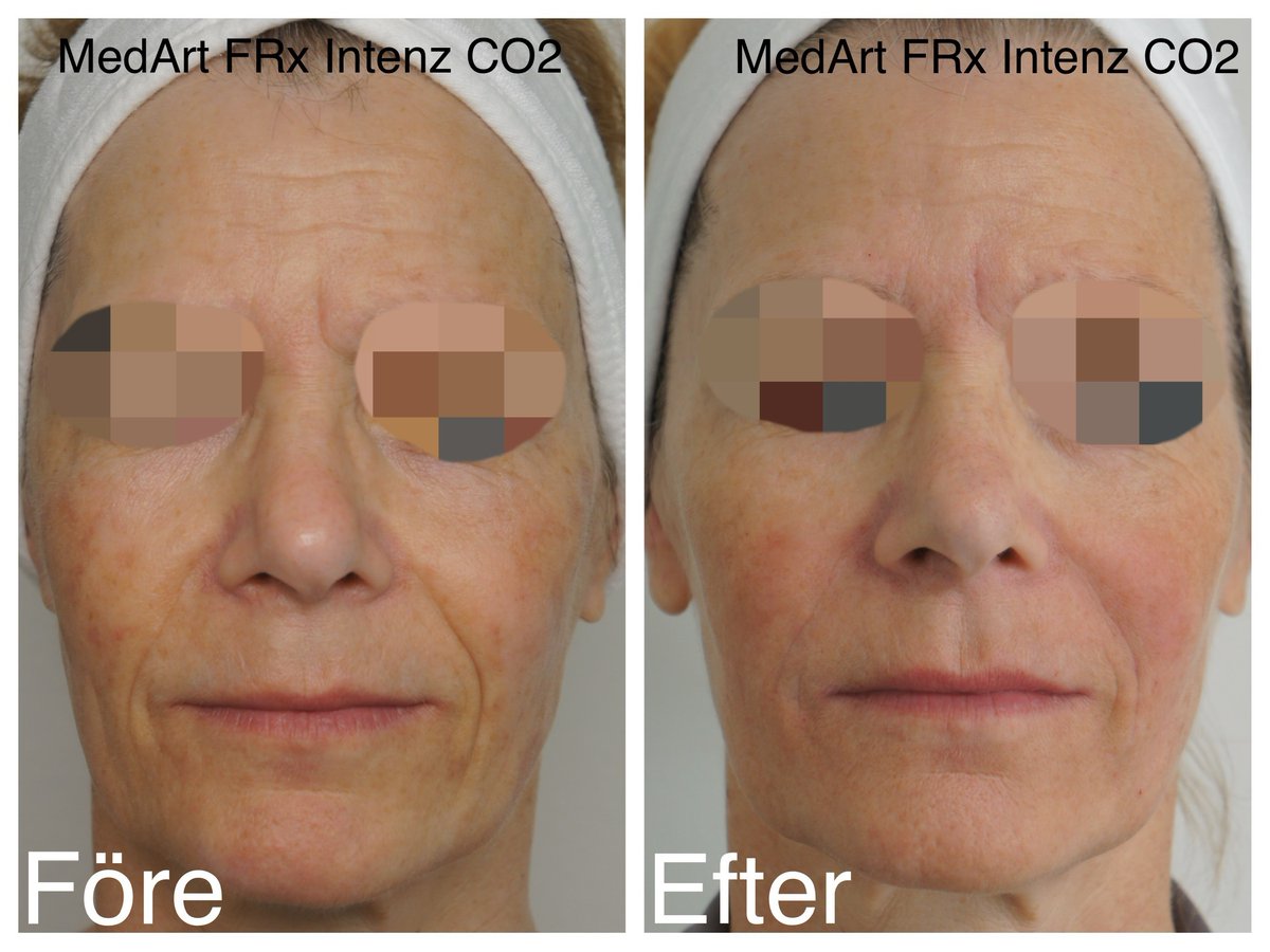 a_medart's tweet photo. Full Face Treatment of Fractional Laser by MedArt FRx Intenz CO2 @doctorryskinclinic 👍👍💐💐
non-invasive, fast recovery &amp; effective resurfacing.
👍 with MedArt Scanner, full face treatment takes less than 30 minutes.
Visit: https://t.co/UGp7TxwGIv
#co2laser #fractionsllaser https://t.co/dYm00hOL4F