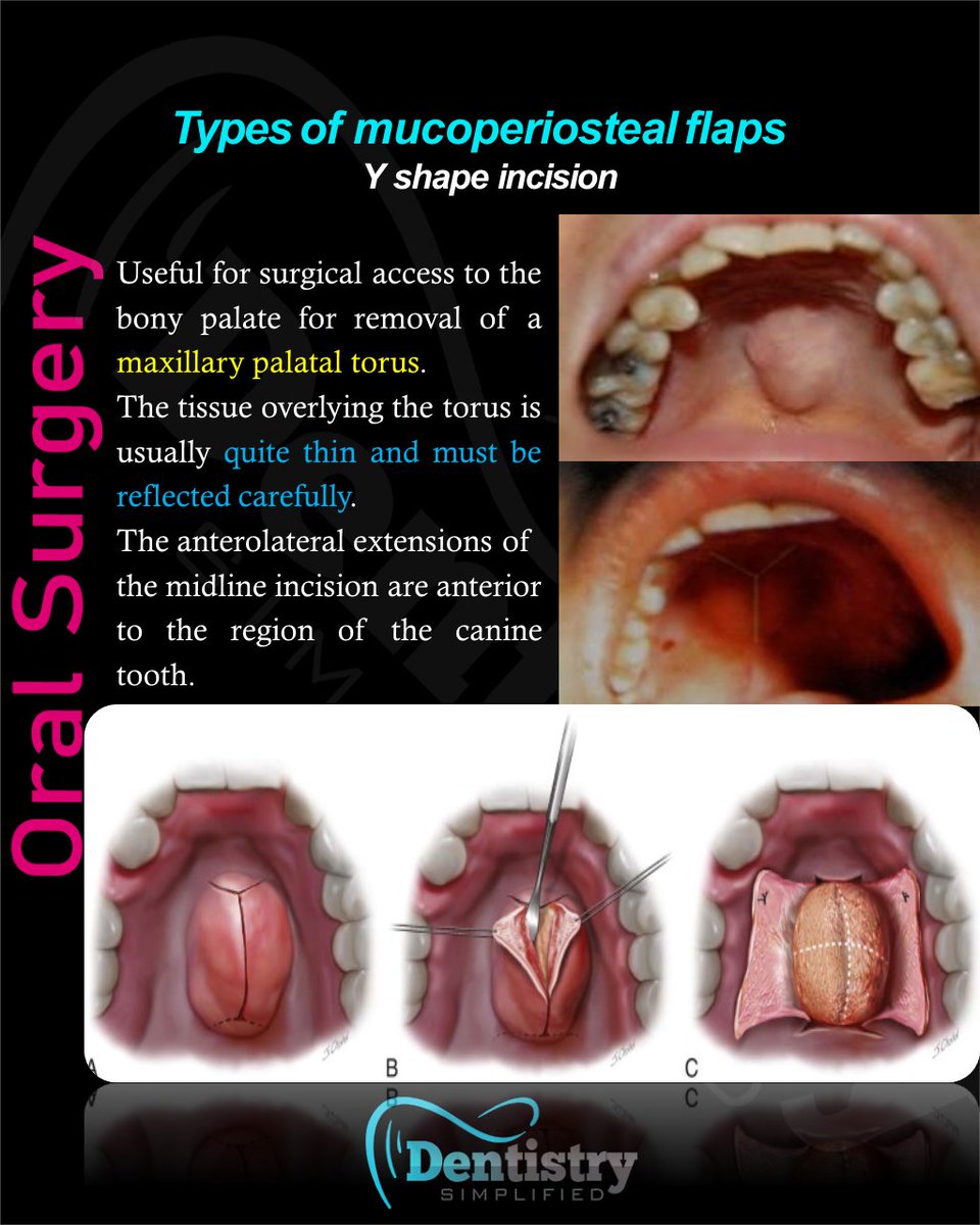 Dent_Simplified's tweet photo. Flap design: Y shaped incision

#Dentistrty #Oral_Health #mds #dds #mdsprep  #mdspreparation  #next_exam #bds  #dental #dentistry #dentists #dentalstudent #dentalcare #nbe #neet_dental #oral_histology #Endodontics #Endo #oralmedicine #medicine #oralsurgery #OMFS #nbde https://t.co/bn0detgKqZ
