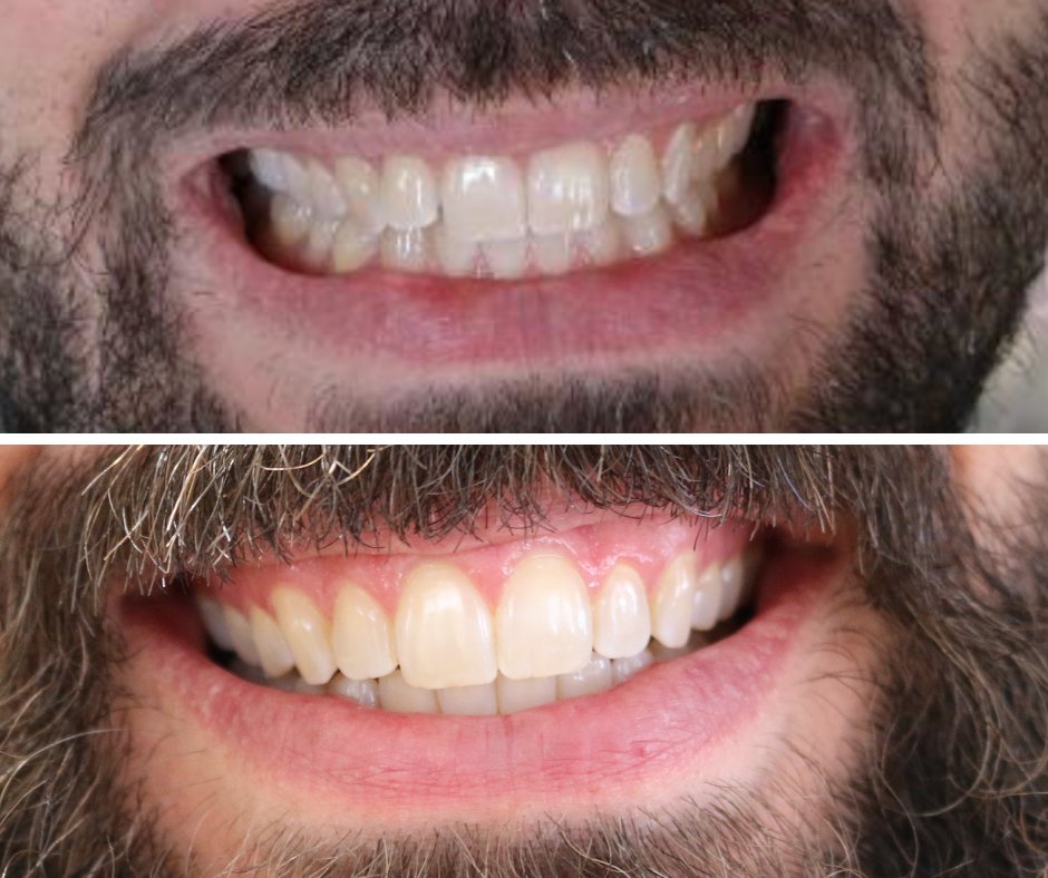 When you do clear aligner treatment with us, we want your smile perfect without any negative effects on your health. Our aligners are made without BPA or phthalates. 
#holisticdentistry #biocompatibledentistry