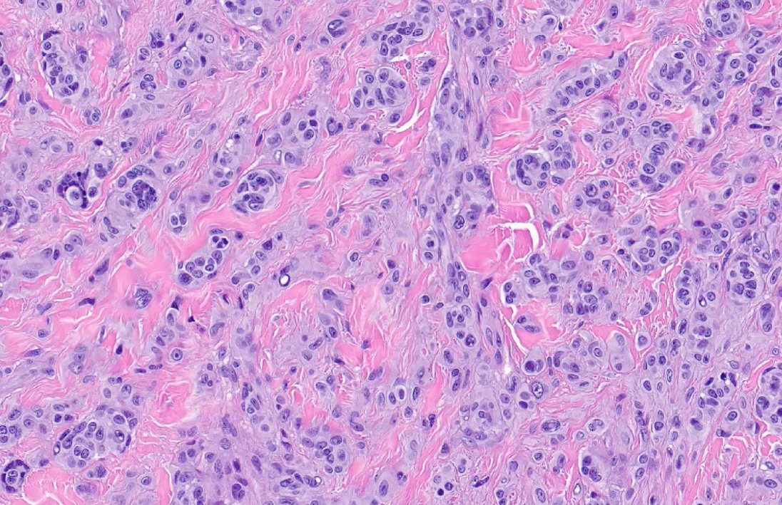 SimonRoyMD's tweet image. If you're at #ASDP2020, feel free to check out our Duel presentation about BRAF-fused Spitz tumors in a patient with ring chromosome 7 syndrome. Video accessible anytime during!