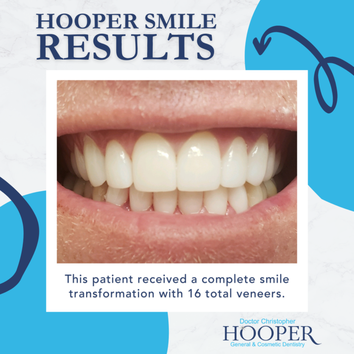 drhooperdds's tweet photo. This patient received a complete smile transformation with a total of 16 veneers! Are you ready for real smile results? Contact us today! 🖥📞 #SmileResults #SmileTransformations #HooperSmiles #HooperDentistry #DrHooper #VBDentist #VirginiaBeachVA https://t.co/4MowLQD3yE