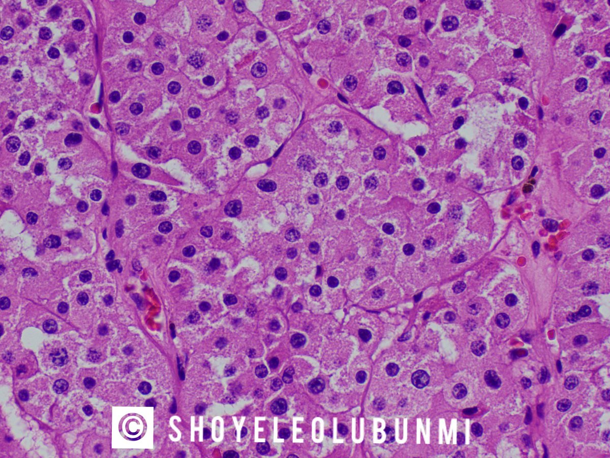 ShoyeleOlubunmi's tweet photo. #PathPourri
Case 7: Renal Oncocytoma.
Gross image, H&E, CD117 & CK7 https://t.co/N8HPcbLEO5