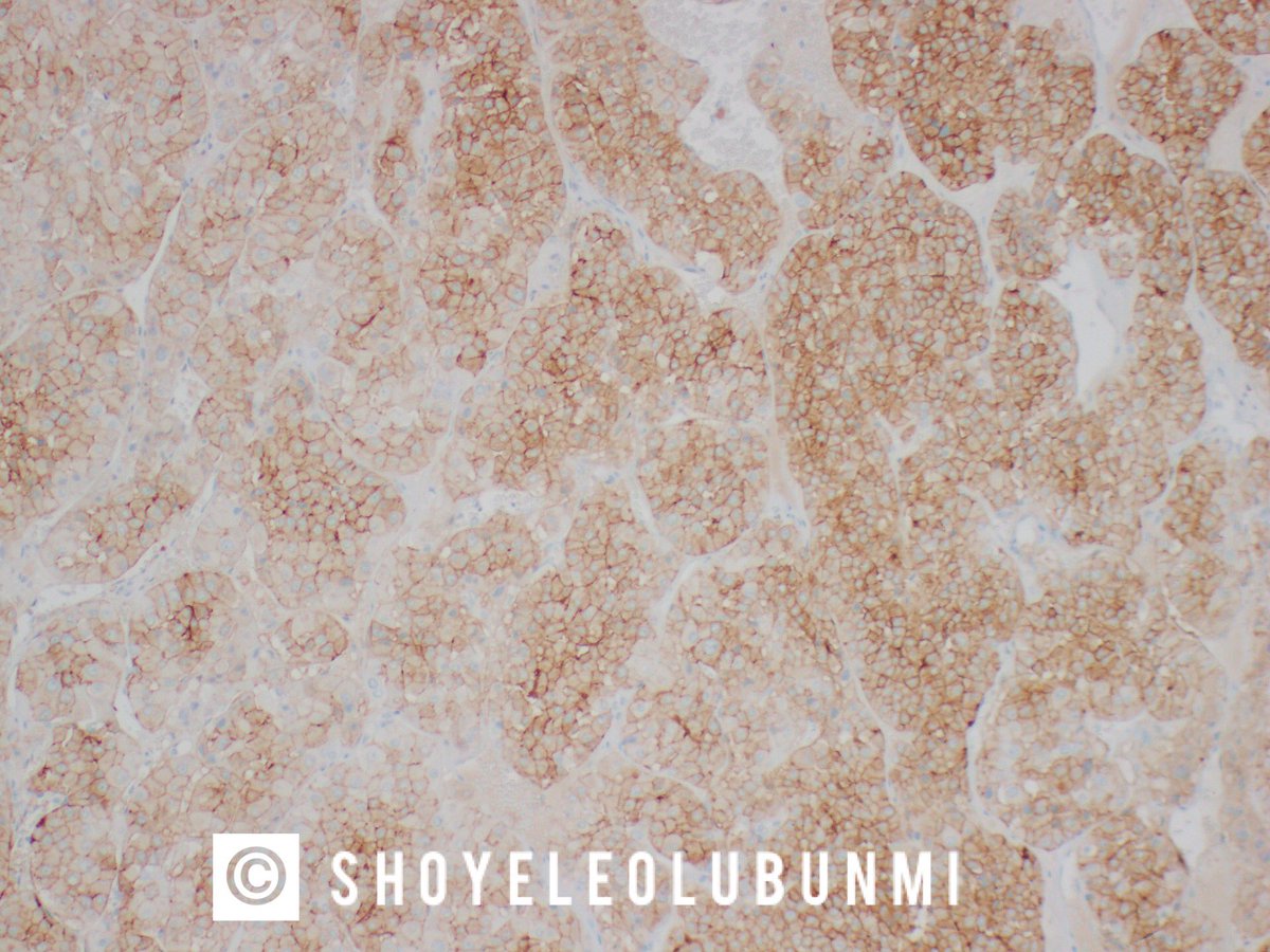 ShoyeleOlubunmi's tweet photo. #PathPourri
Case 7: Renal Oncocytoma.
Gross image, H&E, CD117 & CK7 https://t.co/N8HPcbLEO5