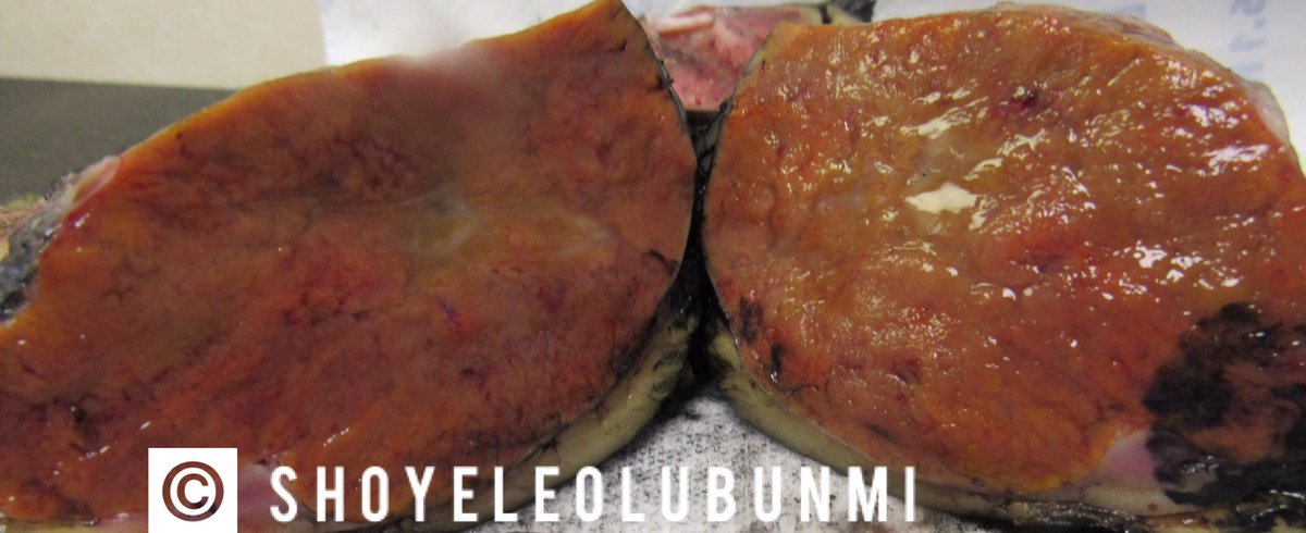 ShoyeleOlubunmi's tweet photo. #PathPourri
Case 7: Renal Oncocytoma.
Gross image, H&E, CD117 & CK7 https://t.co/N8HPcbLEO5