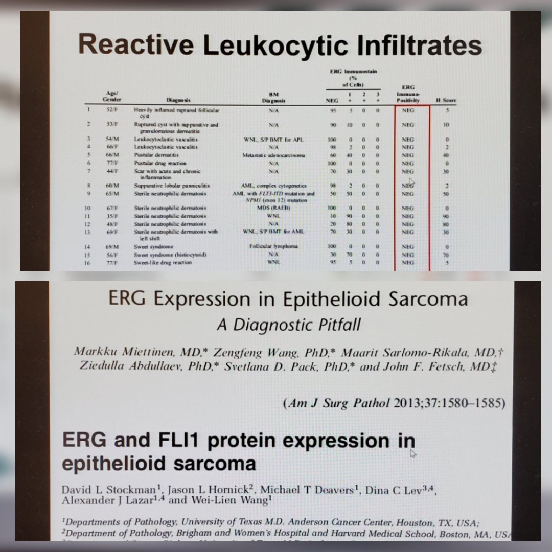 DrSarahDerm's tweet image. ERG is often positive in leukemia cutis (neg in reactive infiltrates) and certain clones of epithelial sarcoma. @KonstantinosLin @ASDPTweets #ASDP20 #asdp2020 #sarcoma #skincancer