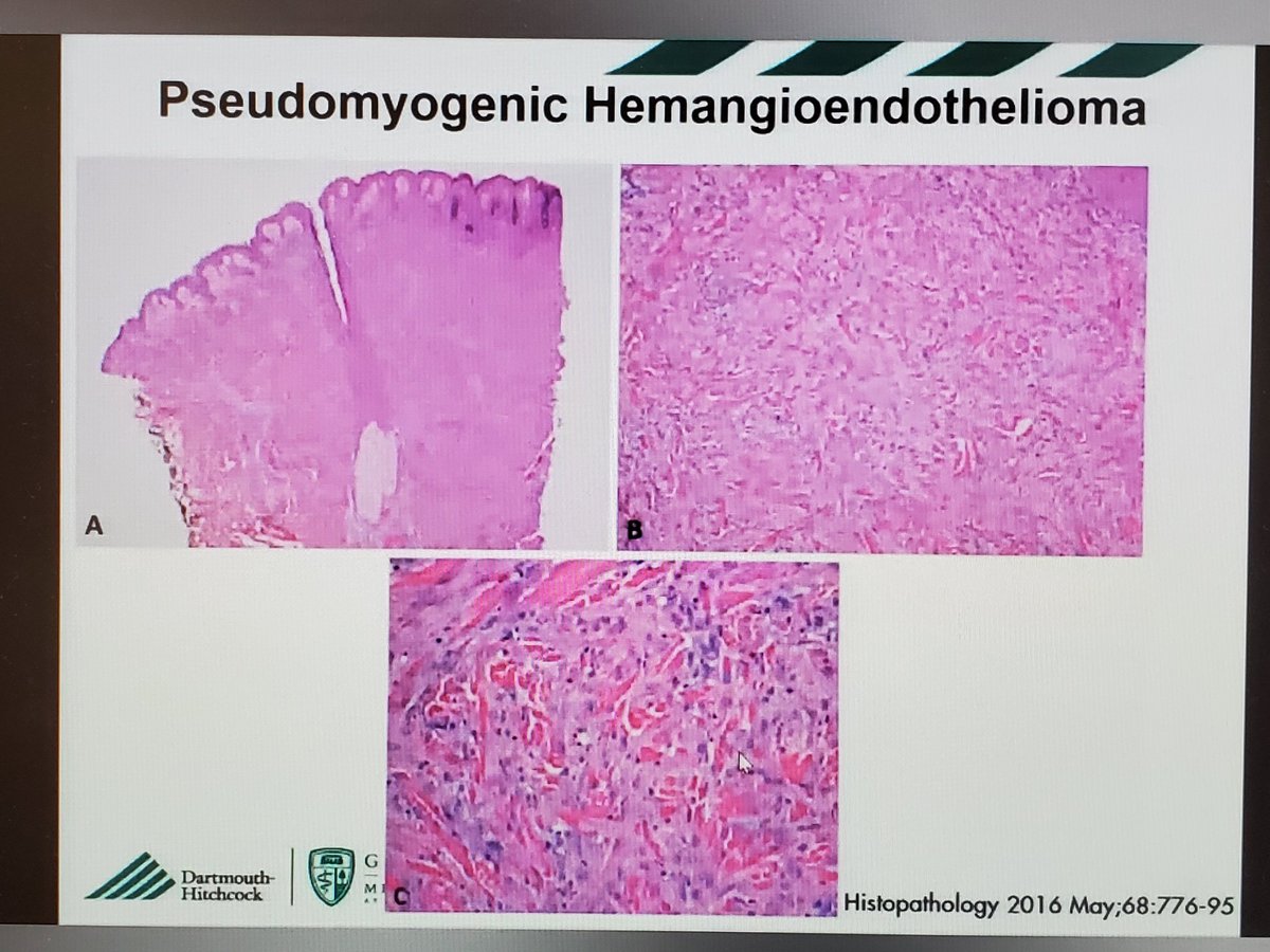 DrSarahDerm's tweet image. Important mimic of cellular dermatofibroma = pseudomyogenic hemangioendothelioma. Look for neutrophils as a clue. Important ddx bc the latter has a high risk of recurrence with intermediate malignant potential. @KonstantinosLin @ASDPTweets #ASDP20 #asdp2020
