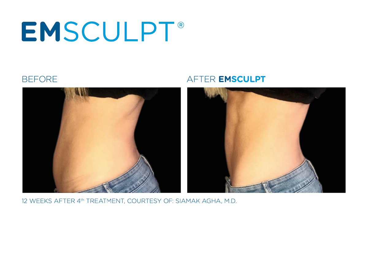 WestsideLaserCA's tweet photo. Say goodbye tot hours in the gym and say hello to The EM Club! 

Give us a call at 403.685.0110 to learn more about how Westside Laser &amp; Light can help you achieve and sculpt the body you're working for 💪🏼

#goodbyegym #emscuplt #healthyliving #btlemsculpt #bodysculpting #medispa https://t.co/0fmpGOj1qw