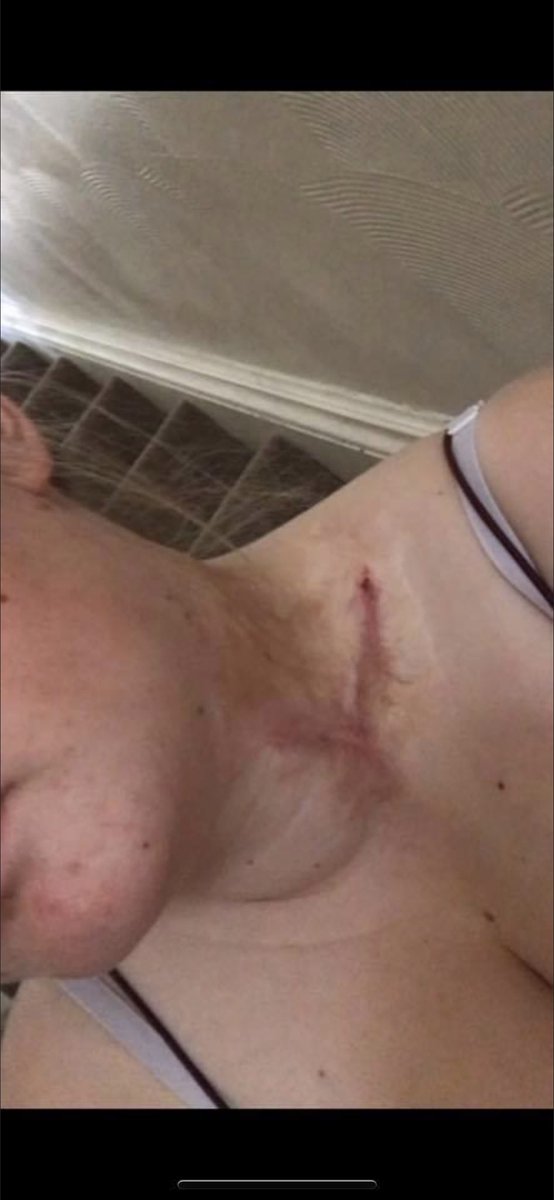 AbbWharts's tweet photo. TW- scars, burns, blood...
A time-line of the last 10 years. The first picture was AFTER some healing and grafting, the last is how absolutely unreal she now looks! Please, for the love of God, be careful today! #bonfirenight #fireworks #sister #fireworkburn https://t.co/cIPbQmnJkh