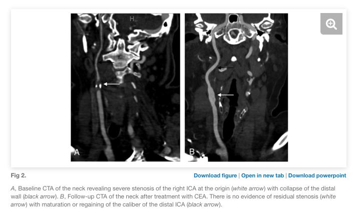 12/In our series, long-term outcomes showed higher rates of restenosis or asymptomatic interval occlusion than in carotid stenosis without near-occlusion. Still, 79% (stent) and 84% (CEA) had maturation of the revascularized carotid with return of normal vessel caliber.