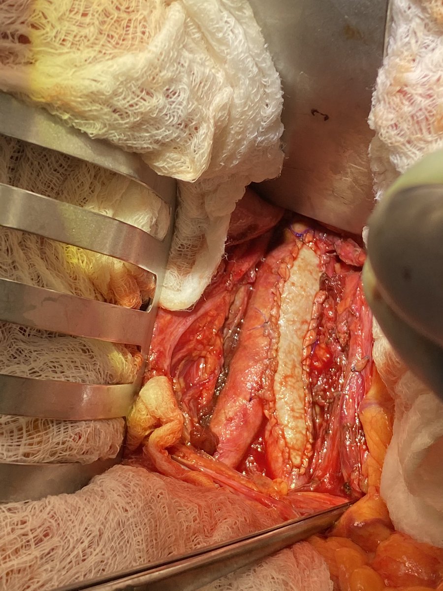 michaelcsiah's tweet photo. Aortic thrombus in young patient with rest pain and gangrene treated with a scalpel! Never saw one of these in training but aortic endarterectomy is still alive in Texas! #lookslikebigcommonfemoralendart #withascalpel #vascular https://t.co/1TiKaZIYa1