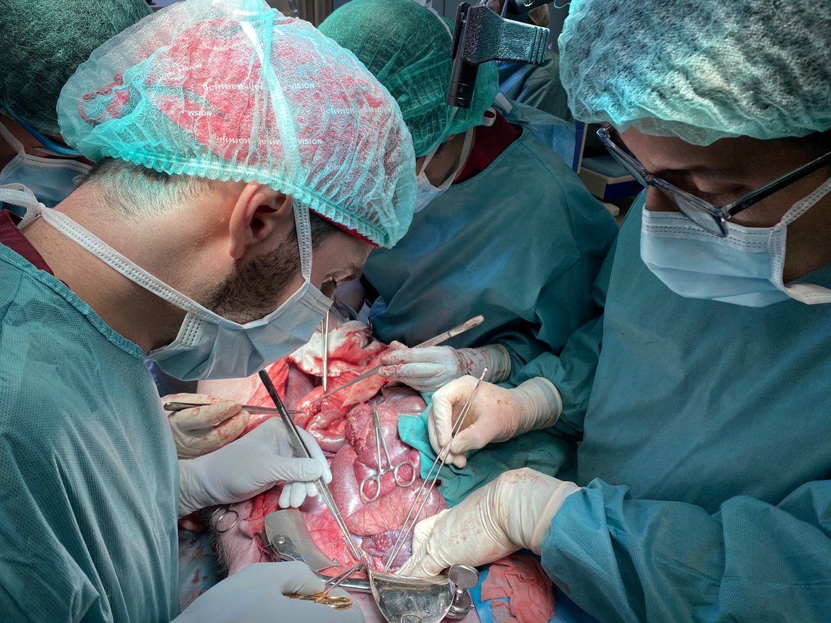 Pablo Muriel (@pmuriel_al) on Twitter photo Después del magnífico webinar de resección vascular del Dr. Emilio Vicente en <a href="/IHPBA/">IHPBA</a> y <a href="/aecirujanos/">aecirujanos</a> el staff joven de <a href="/Hbp_EgLleida/">Cirugía HBP y Gástrica H. Arnau de Vilanova Lérida</a> ha querido ponerlo en práctica gracias a nuestro centro <a href="/creballeida/">CREBA</a>
#surgicaltraining @seccionhbpaec <a href="/MikelPrieto4/">Mikel Prieto</a> <a href="/JjOlsina/">JJOlsina</a> <a href="/aecformacion/">AEC Formación</a> <a href="/MIAGB2/">Miguel Angel Gomez Bravo</a> Después del magnífico webinar de resección vascular del Dr. Emilio Vicente en <a href="/IHPBA/">IHPBA</a> y <a href="/aecirujanos/">aecirujanos</a> el staff joven de <a href="/Hbp_EgLleida/">Cirugía HBP y Gástrica H. Arnau de Vilanova Lérida</a> ha querido ponerlo en práctica gracias a nuestro centro <a href="/creballeida/">CREBA</a>
#surgicaltraining @seccionhbpaec <a href="/MikelPrieto4/">Mikel Prieto</a> <a href="/JjOlsina/">JJOlsina</a> <a href="/aecformacion/">AEC Formación</a> <a href="/MIAGB2/">Miguel Angel Gomez Bravo</a>