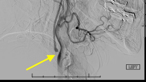 1/A  #tweetorial on carotid near-occlusion:A right-handed patient presents with 3 transient recent events: left BRAO, expressive aphasia, and right hand weakness. Imaging revealed a left carotid near-occlusion, which is defined as having ≥2 of the following 4 criteria: