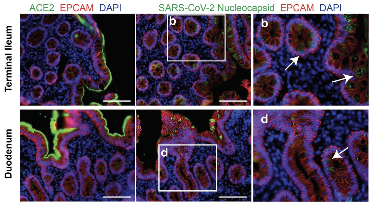 Remarkably, we detected SARS-CoV-2 antigen in the gastrointestinal tract of several participants using immunostaining. 8/