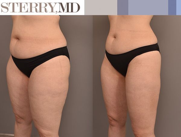 DrSterry's tweet photo. Real Patients, Real Results!
This is the result of Inner Thigh Liposuction, Outer Thigh Liposuction and Knee Liposuction. We could not be happier with these results.
#plasticsurgery #innerthighs #innerthighslipo #outerthighs #outerthighslipo https://t.co/P884sBcVk9