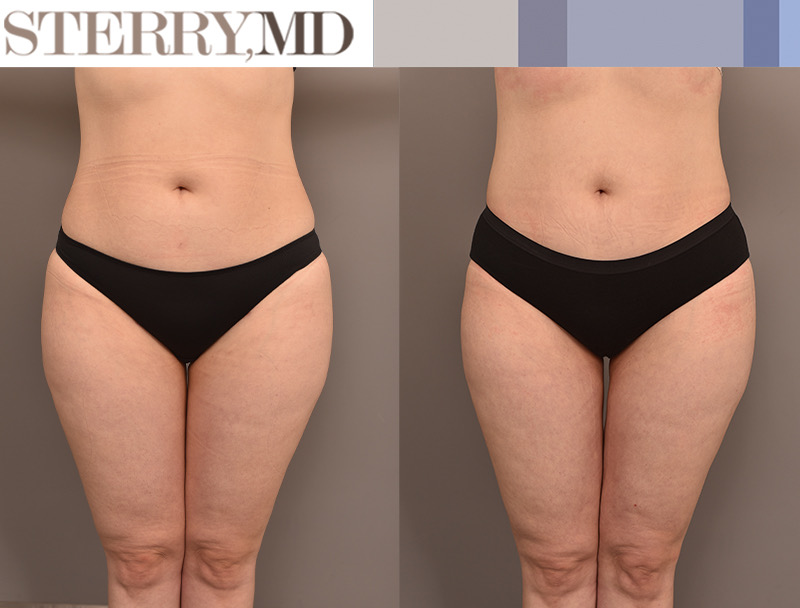 DrSterry's tweet photo. Real Patients, Real Results!
This is the result of Inner Thigh Liposuction, Outer Thigh Liposuction and Knee Liposuction. We could not be happier with these results.
#plasticsurgery #innerthighs #innerthighslipo #outerthighs #outerthighslipo https://t.co/P884sBcVk9