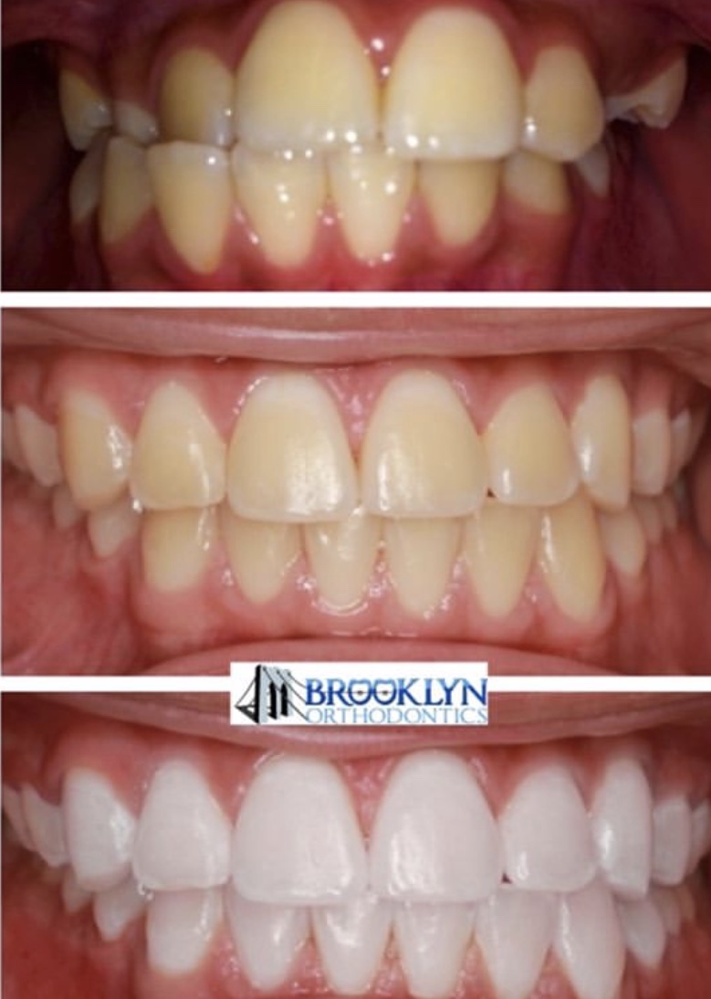 Happy Thursday Everyone, enjoy this before and after! #TBT 
#zoomwhitening #braces