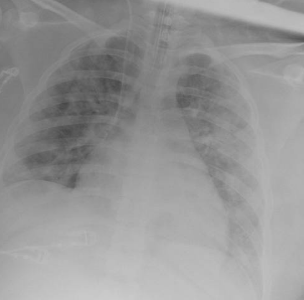 infecto79's tweet photo. Hace unos dias llegó un mujer embarazada con #COVID19 que requirió intubación y ventilación mecánica. Se realizó cesárea y la recien nacida requirió ventilación mecanica y cuidados críticos; hoy ambas estan recuperandose en casa: increible labor de todos (#HU staff drops the mic) https://t.co/e4LADb4Fdq