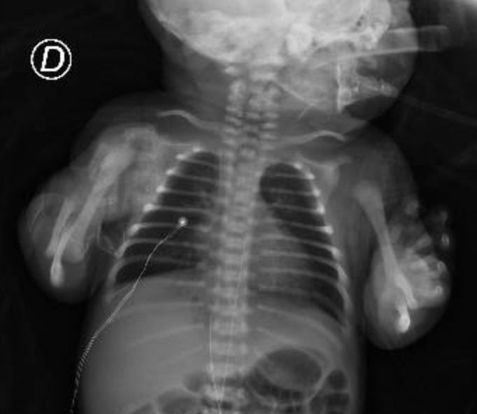 infecto79's tweet photo. Hace unos dias llegó un mujer embarazada con #COVID19 que requirió intubación y ventilación mecánica. Se realizó cesárea y la recien nacida requirió ventilación mecanica y cuidados críticos; hoy ambas estan recuperandose en casa: increible labor de todos (#HU staff drops the mic) https://t.co/e4LADb4Fdq
