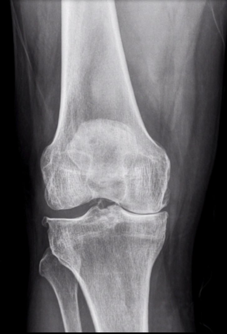 Importance of #weightbearing Xray! 🦵🏾#knee #OA #osteoarthritis ⚠️