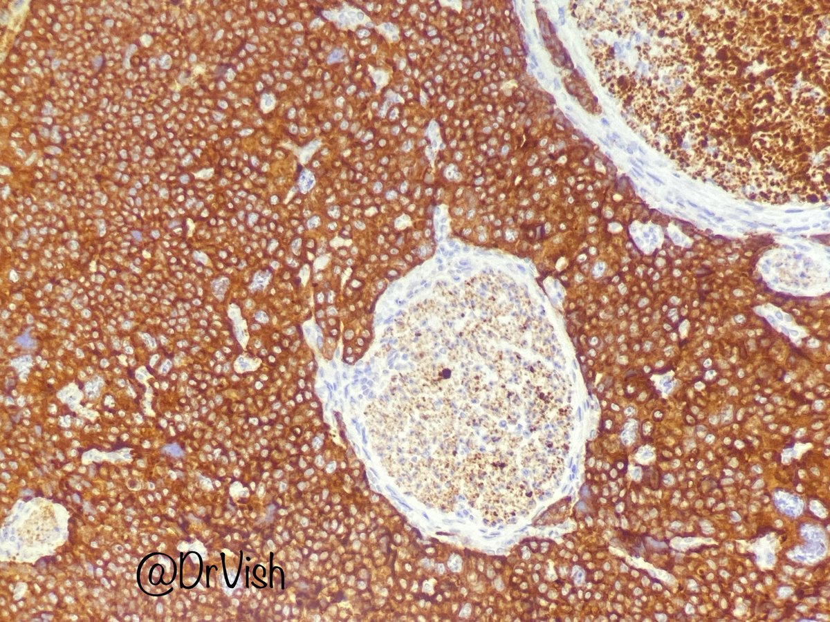 DrVish's tweet photo. Guess the stain #pathfiles @ac_pathgal @b_histopath @ALBoothMD @dr_happylight @Gagandeepk5MD @EviAbadaMD @Huy_NguyenMD @DrGeeONE @DrAKumarPath @TheKarenPinto @PolancoMd @kkuanMD @Dr_Brian_Cox @SwikrityUMD @olopeznu @Miryousufkhan3 @DonthiDeepak @padmapathology1 @Meghna0630 https://t.co/sNKReKtl9a