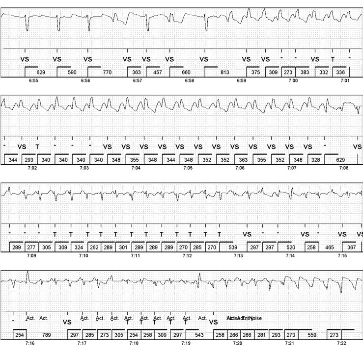 peterkistler3's tweet image. ILR with remote monitoring in a young man after single episode of syncope. prior negative EPS, ECG minor early repol, echo, CMR normal. Nervous call! survived 😅