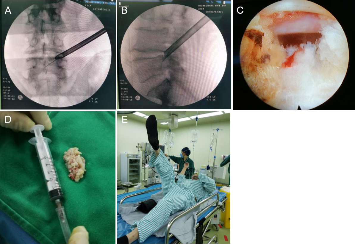 ctod_editor's tweet photo. #CTOD [Research Article] Efficacy and prognosis of transforaminal endoscopy in the treatment of lumbar disc herniation in patients infected with human immunodeficiency virus: a nonrandomized, controlled, 2-year follow-up clinical study

https://t.co/N8mt4a6KKF https://t.co/gAEHBODcWx
