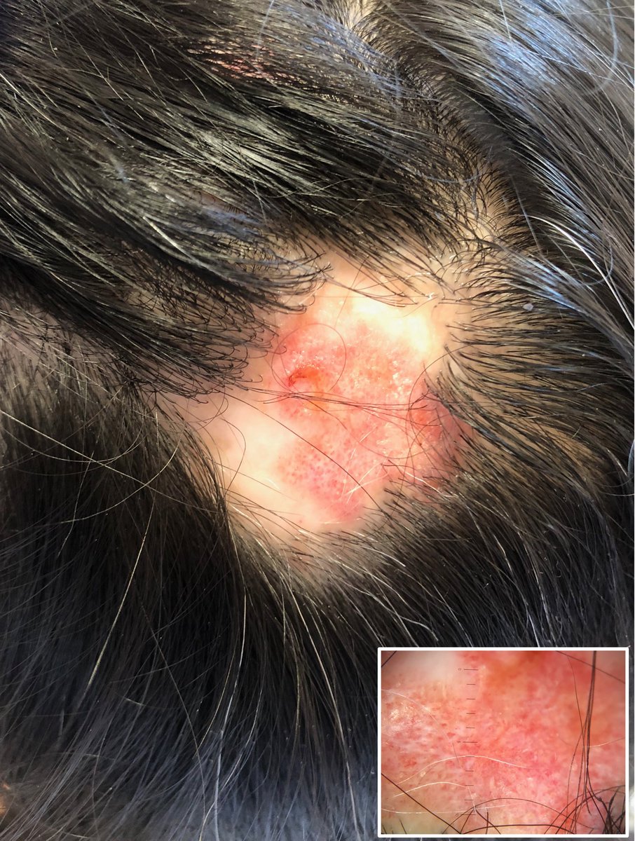 Mujer de 58 años con alopecia cicatricial por #lupus cutáneo crónico. 🧑🏼‍🦰
Este tipo de alopecia cicatricial responde muy bien al tratamiento con hidroxicloroquina oral e infiltraciones de triamcinolona intralesional. 💊💉

#tricoHRC #GrupoPedroJaen #dermatologia