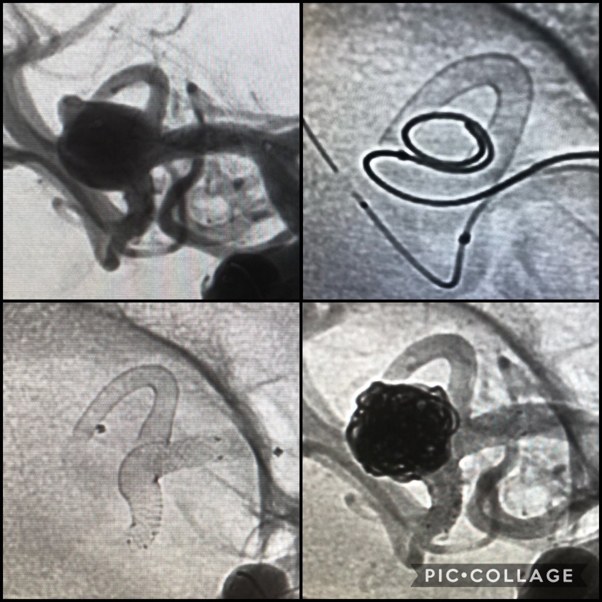 RLHINR's tweet photo. Elective wide necked MCA #aneurysm. Patient refused open surgery. #RadialforNeuro #FlowT #stent and #coil #embolisation with @BaltSpain #vista and #MV #evo (with compression) stent to scaffold. Good angiographic result. Patient home on day 1. #withoutascalpel #FridayFeeling https://t.co/xMjnSweY3y