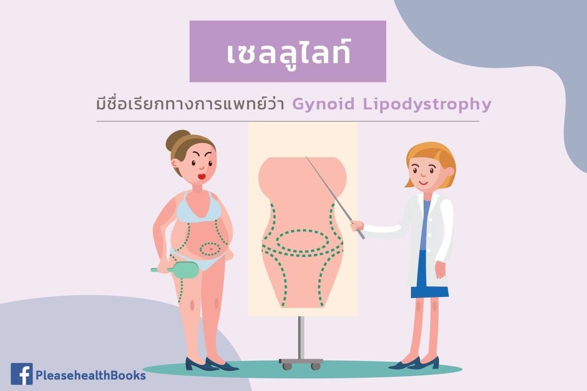 thidakarn's tweet photo. #เซลลูไลท์ หรือ เปลือกผิวส้มที่ผู้หญิง 9 ใน 10 คนแอบมีซ่อนอยู่ มีชื่อเรียกจริงจังว่า Gynoid lipodystrophy จัดเป็นโรครักษายาก แต่มีทางเลือกในการรักษาได้ ควบคู่กับการปรับไลฟ์สไตล์ค่ะ https://t.co/lX91Cgp7Zl