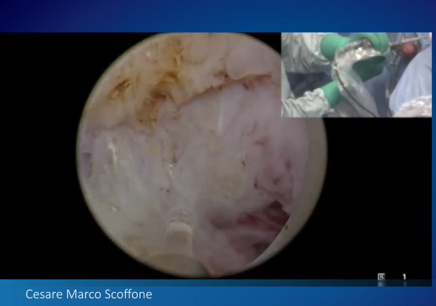 OlympusUrology's tweet photo. #SoLEP performed by @scoffonecesare at #TnT2020 today. Great discussion about tips &amp; tricks from leading experts in the field of #BPH treatment.
@EndourologyT https://t.co/cKfb0UHsSz