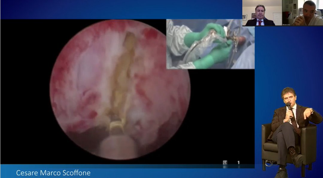 OlympusUrology's tweet photo. #SoLEP performed by @scoffonecesare at #TnT2020 today. Great discussion about tips &amp; tricks from leading experts in the field of #BPH treatment.
@EndourologyT https://t.co/cKfb0UHsSz