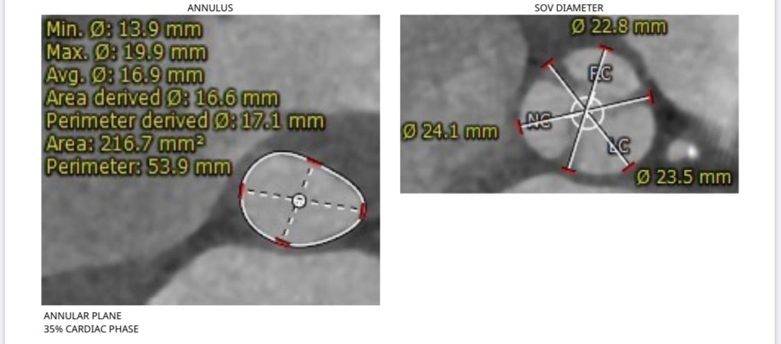AlkashkariWail's tweet photo. 🔴 Challenging case with 67♀️critical AS(MPG 60)EF55% very small Annuli⛔️ Area216mm, Perimeter53.9mm, Narrow SOV.
#TAVR #EVOLUTER 23 #Commissural_alignment #CUSPS_OVERLAP
Marvelous results with invasive MG7(TTE10)NO PVL,NO ECG.
@GilbertTangMD @GuiAttizzaniMD @Almanfi_Cardio https://t.co/Z7G3MbiBDN