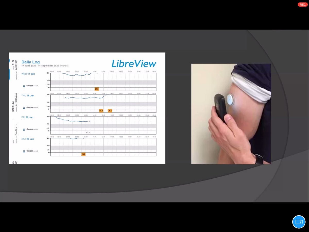 Self management is challenging, particularly in young people worried about weight gain.