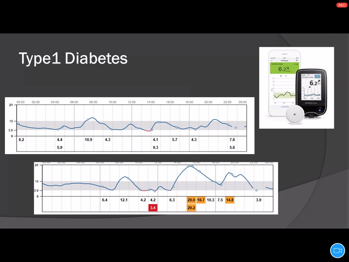 Continuous glucose monitoring helps both with glucose control and disordered eating