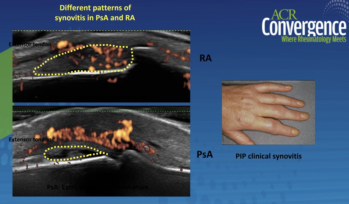 JonathanDauMD's tweet photo. #Twearls for Enthesopathy US in #psoriasis arthritis and SpA #ACR20 by Dr. Bakewell
Achilles Thickness:
> Have patient extend tendon to 180 degrees, see figure below (Figure B)
> Compare contralateral tendon
RA synovitis vs PsA enthesitis
> Doppler in PsA is in tendon
#mskus https://t.co/HynYkiR4sn