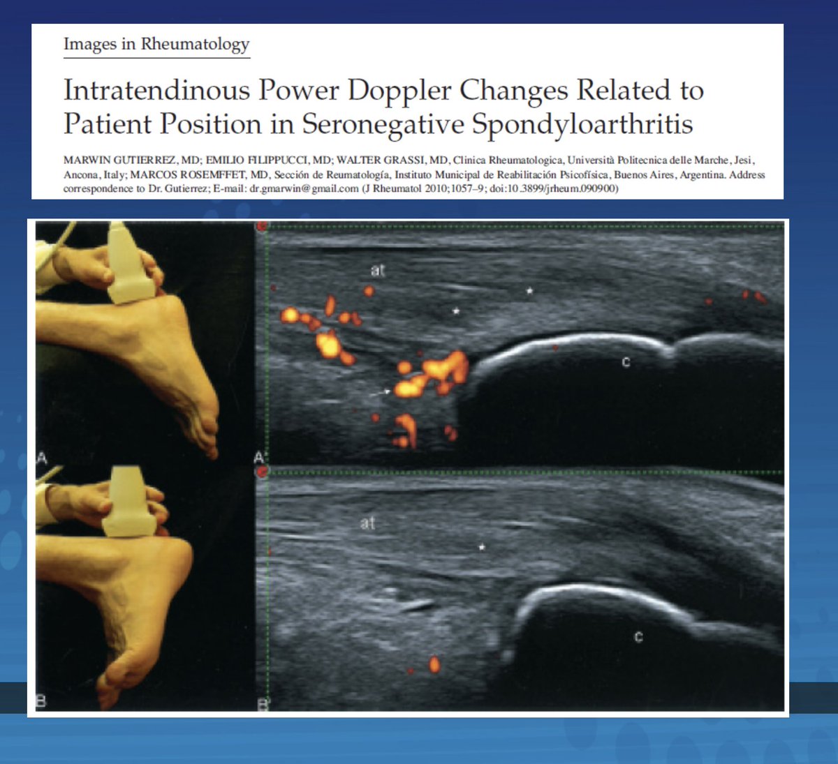 JonathanDauMD's tweet photo. #Twearls for Enthesopathy US in #psoriasis arthritis and SpA #ACR20 by Dr. Bakewell
Achilles Thickness:
> Have patient extend tendon to 180 degrees, see figure below (Figure B)
> Compare contralateral tendon
RA synovitis vs PsA enthesitis
> Doppler in PsA is in tendon
#mskus https://t.co/HynYkiR4sn