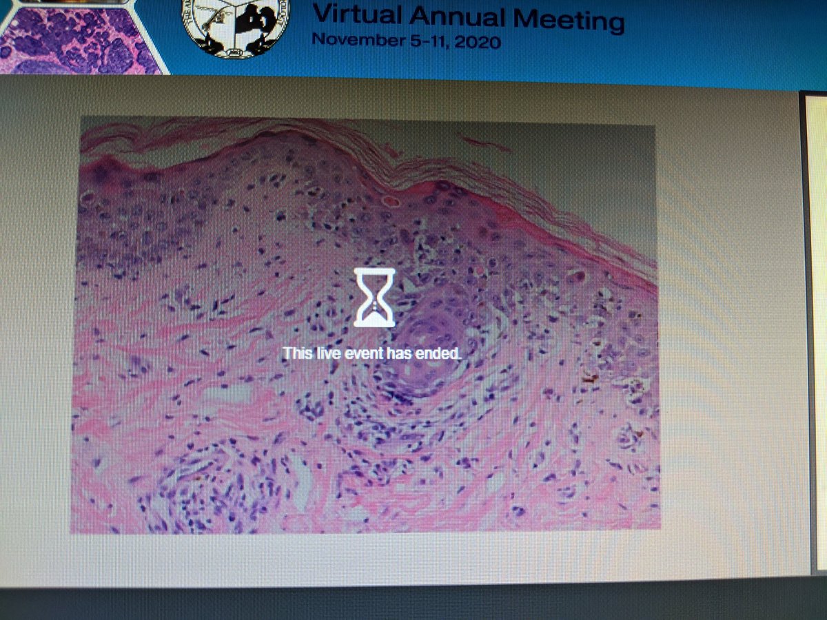 BloomquistSuzy's tweet image. Anyone else keep having this issue with streaming live lectures #asdp2020. It keeps ending the meeting. I relogon and it works for a little while and then ends again. I'm in chrome.