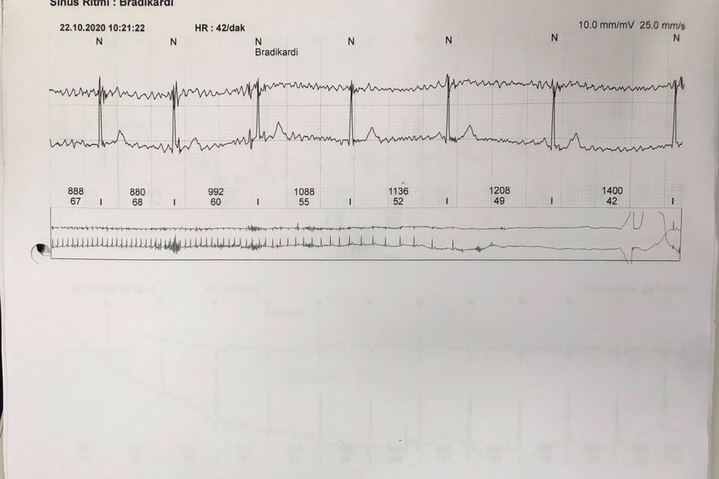 taylanakgun's tweet photo. I referred to @MDTolgaAksu 4-5 recurrent reflex syncope previously. This is the 1st CNA we performed. 36y F, recurr reflex syncope, holter recordings showed asystole during a syncope episode. thanks again @MDTolgaAksu I think this is the one of the most effective procedure of EP https://t.co/W12Za1CdCj