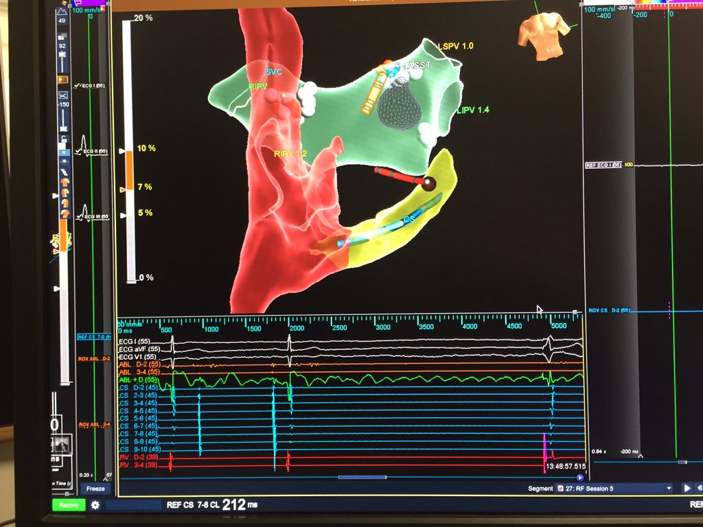 taylanakgun's tweet photo. I referred to @MDTolgaAksu 4-5 recurrent reflex syncope previously. This is the 1st CNA we performed. 36y F, recurr reflex syncope, holter recordings showed asystole during a syncope episode. thanks again @MDTolgaAksu I think this is the one of the most effective procedure of EP https://t.co/W12Za1CdCj