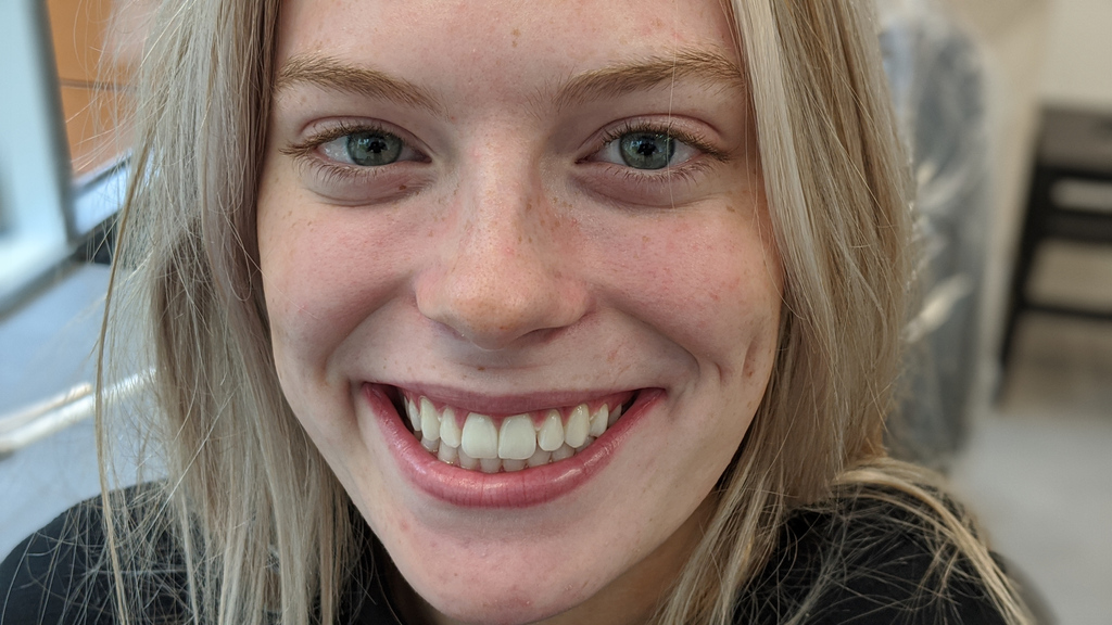 PorthAligner's tweet photo. What's better than that "just finished treatment" feeling?
How about getting those oh-so-perfectly-straight pearly whites even whiter? #PORTHExperience #Invisalign #ClearAligners #Orthodontist https://t.co/C9xNRsxqX5 https://t.co/4UflsmNP5M