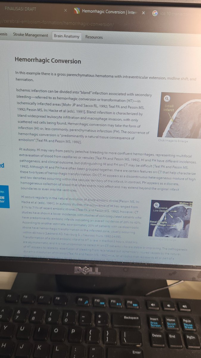 Sungguh sakti ni kepala gw emang sampe sakit baca beginian 😹😂, stroke perdarahan dengan dekompresi otak.