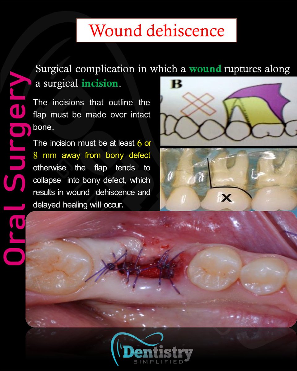 Dent_Simplified's tweet photo. Removable denture surfaces

#Dentistrty #Oral_Health #mds #dds #mdsprep  #mdspreparation  #next_exam #bds  #dental #dentistry #dentists #dentalstudent #dentalcare #nbe #neet_dental #oral_histology #Endodontics #Endo #oralmedicine #medicine #oralsurgery #OMFS #nbde https://t.co/FWZDtuaw61