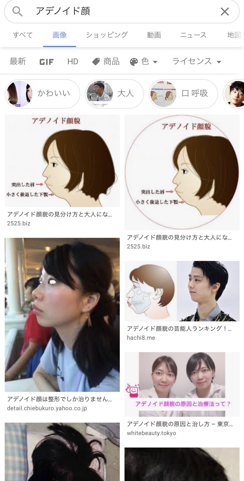 アデノイド顔貌 芸能人 アデノイド顔貌 芸能人