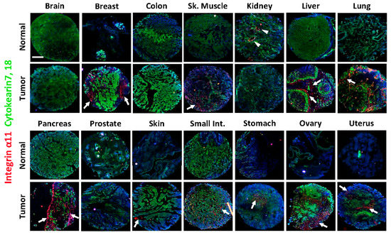 Cancers_MDPI's tweet photo. 🔸α11β1 Integrin is Induced in a Subset of Cancer-Associated #Fibroblasts in Desmoplastic #Tumor Stroma and Mediates In Vitro Cell #Migration🔸
👥by Cédric Zeltz, Jahedul Alam et al.
👉https://t.co/7Z6XIlX5pb
#tumor_microenvironment #tumor_stroma #extracellular_matrix https://t.co/xeb0zeTsvg