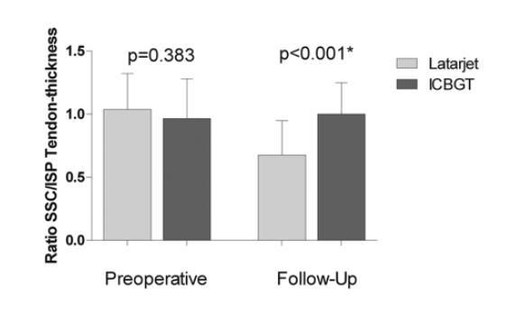 OJSM_SportsMed's tweet photo. Why do #Latarjets lose internal rotation? This study comparing coracoid transfer vs. iliac crest graft showed #subscap thinning and increased rerouting angle in coracoid grafts! #shoulderdislocation @MayoClinic
https://t.co/saAbufmNYX https://t.co/mMXzzILjJY