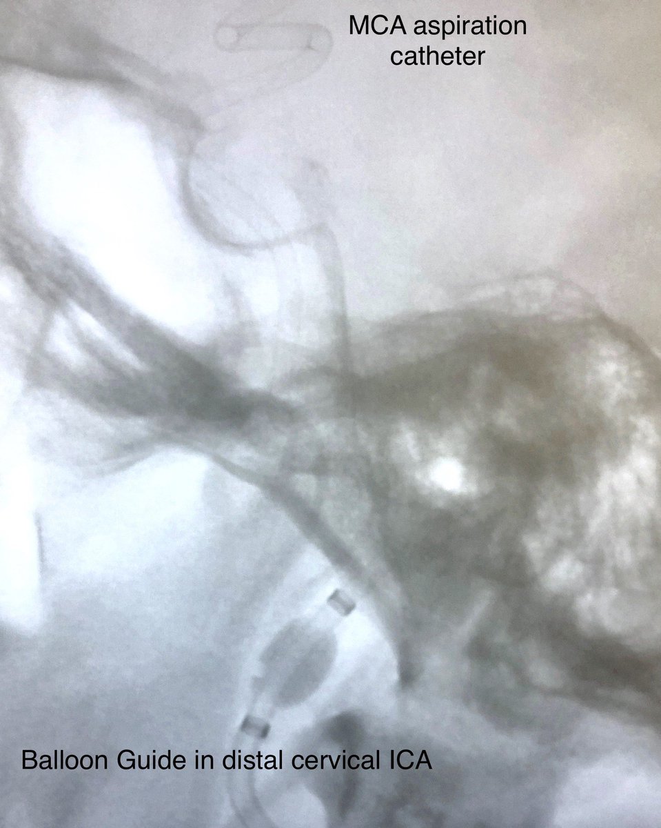 Omar Choudhri Md New Generation Of Navigable Balloon Guide Catheters Are An Essential Step Forward In Stroke Care Versatility In Flow Arrest Reversal Access Support And Angioplasty Combine With Distal Aspiration