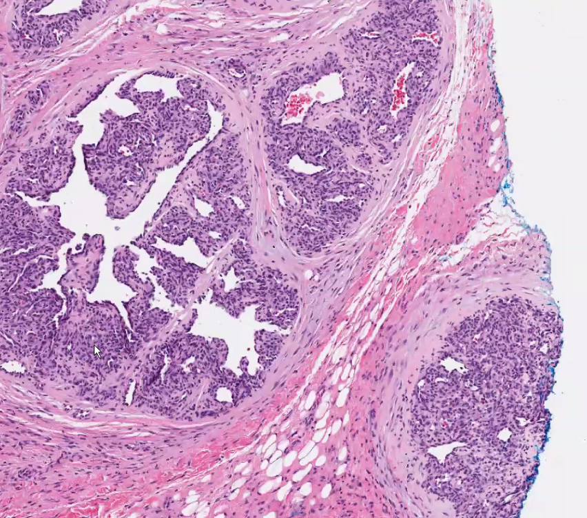 HENRYY_MD's tweet image. Vascular tumor session with Dr Billings #ASDP2020 
pyogenic granuloma can be inside a vessel
#dermpath #bstpath