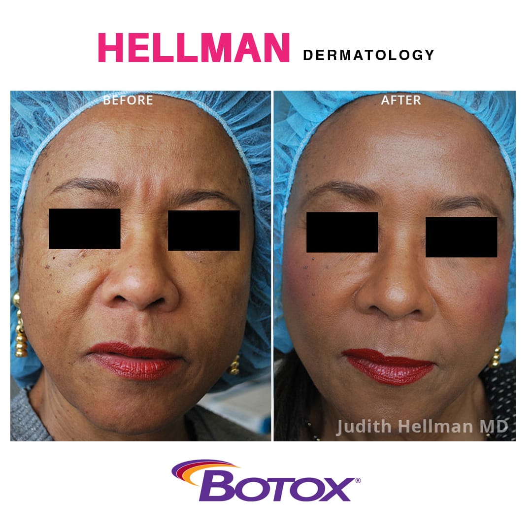 To reduce signs of aging such as frown lines, the "11" between the brows, crow's feet, and as a preventative treatment for the millennials, Dr. Judith Hellman personally and expertly administers Botox and Juvederm for her patients.